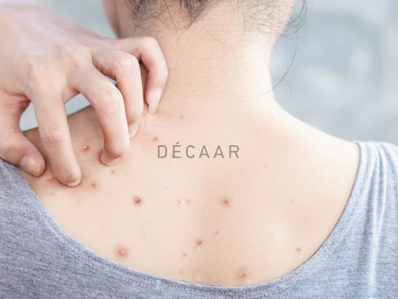 mụn lưng tuổi dậy thì